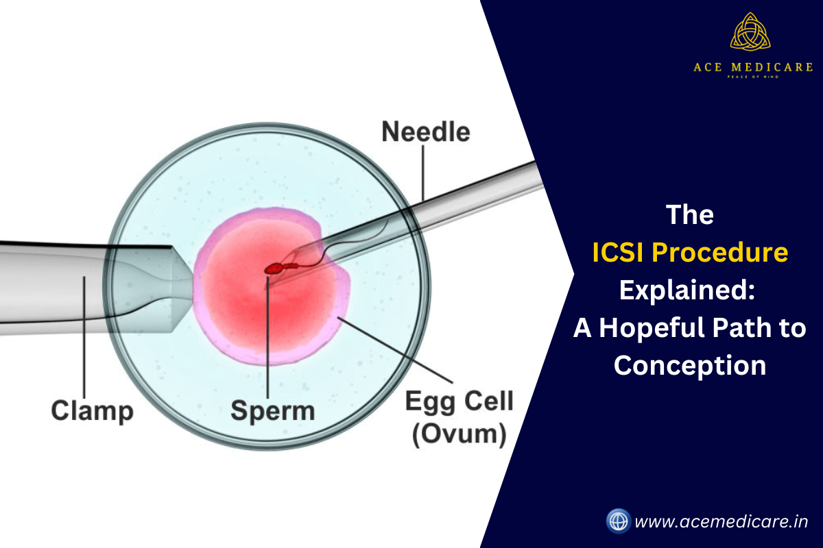 The ICSI Procedure Explained: A Hopeful Path to Conception